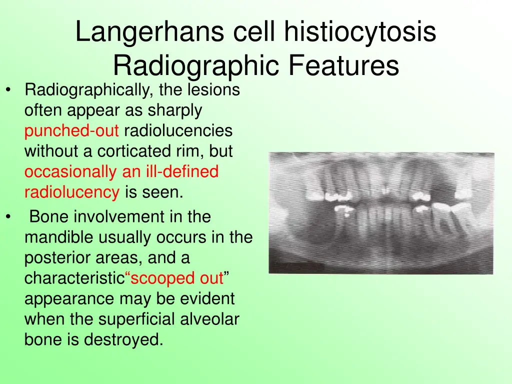 langerhans cell histiocytosis radiographic