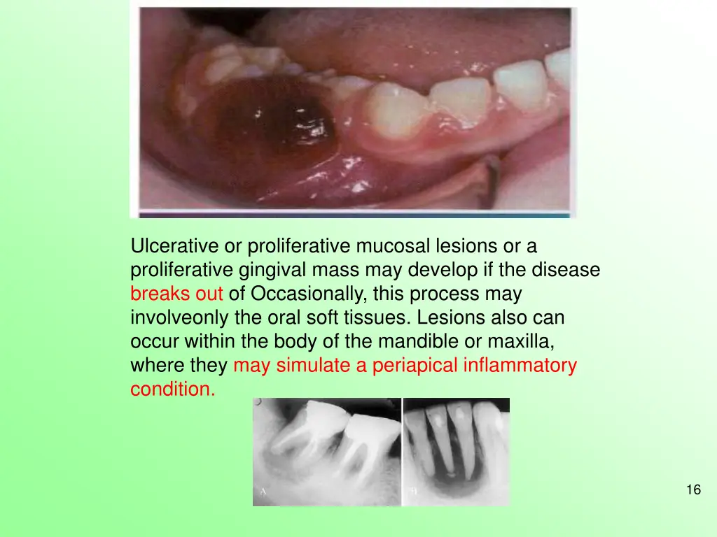 ulcerative or proliferative mucosal lesions