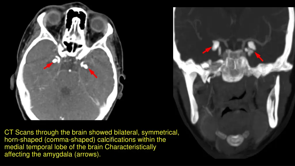 ct scans through the brain showed bilateral