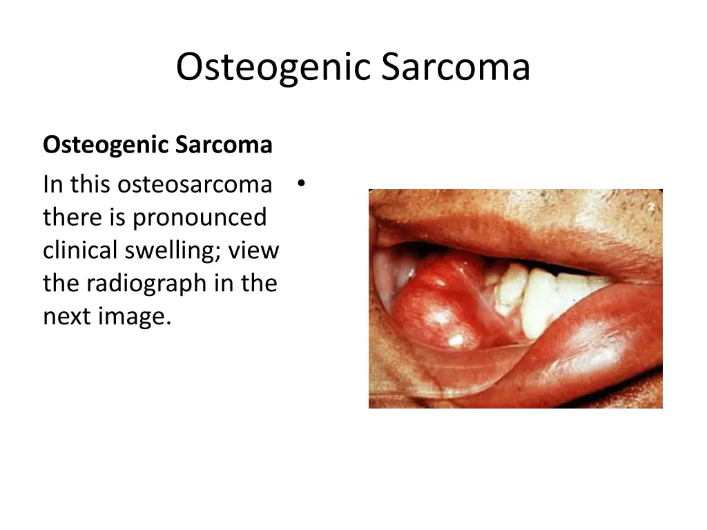 osteogenic sarcoma 1