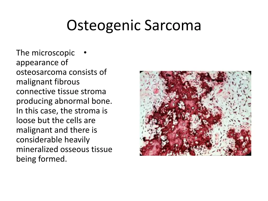 osteogenic sarcoma 10