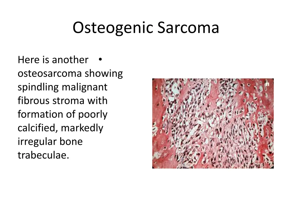 osteogenic sarcoma 11
