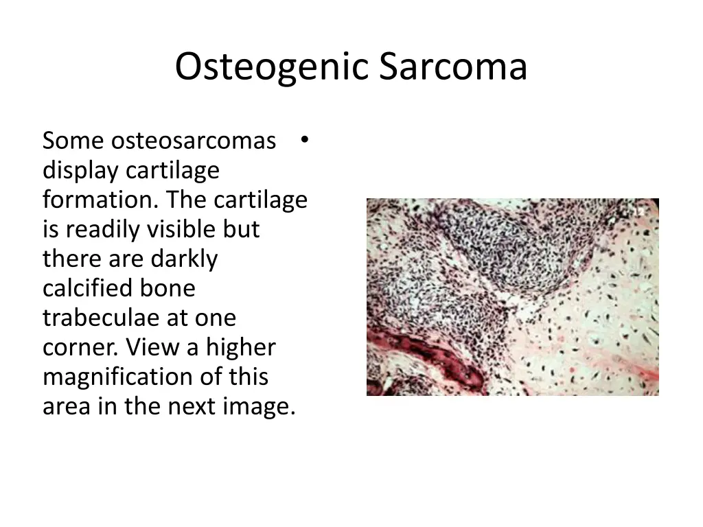 osteogenic sarcoma 12
