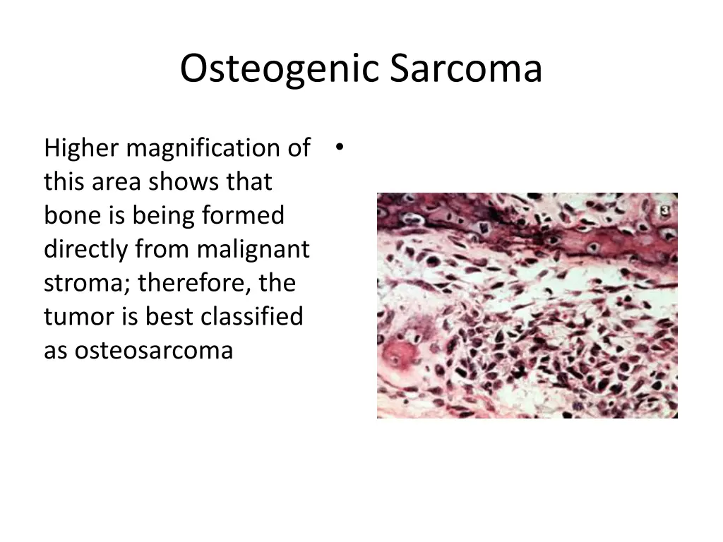 osteogenic sarcoma 13