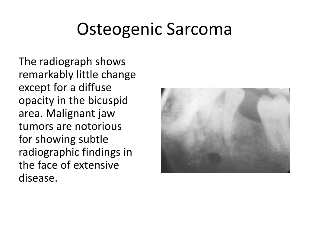 osteogenic sarcoma 2