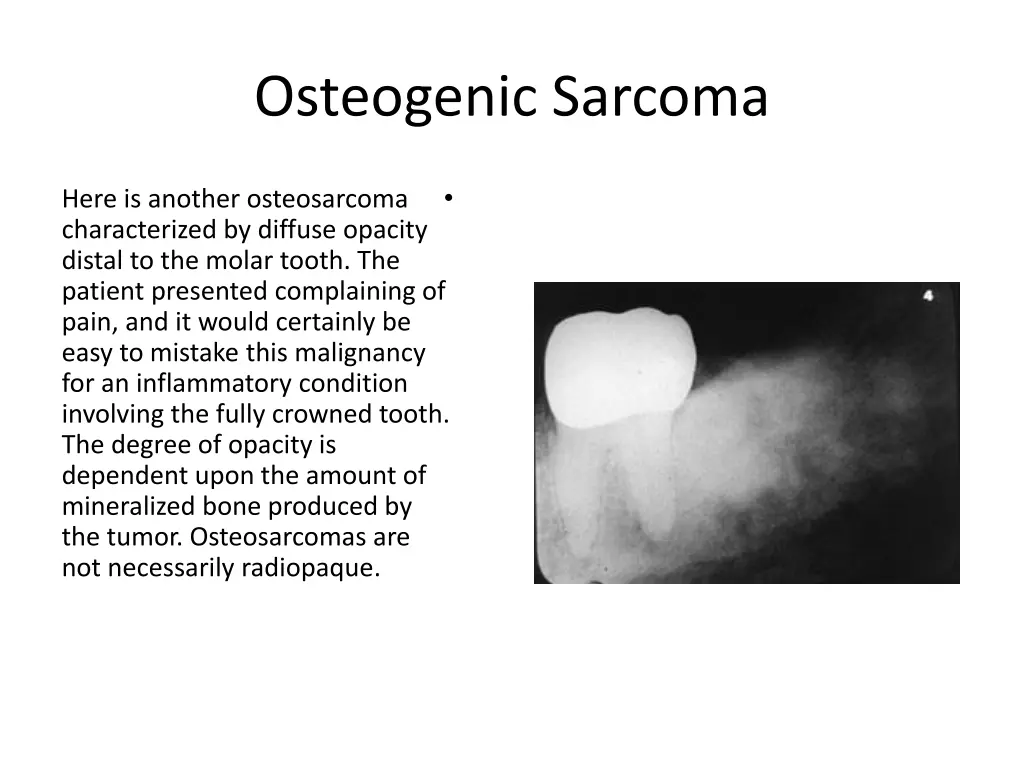osteogenic sarcoma 3