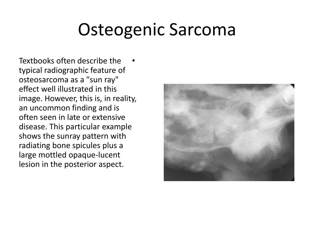 osteogenic sarcoma 5