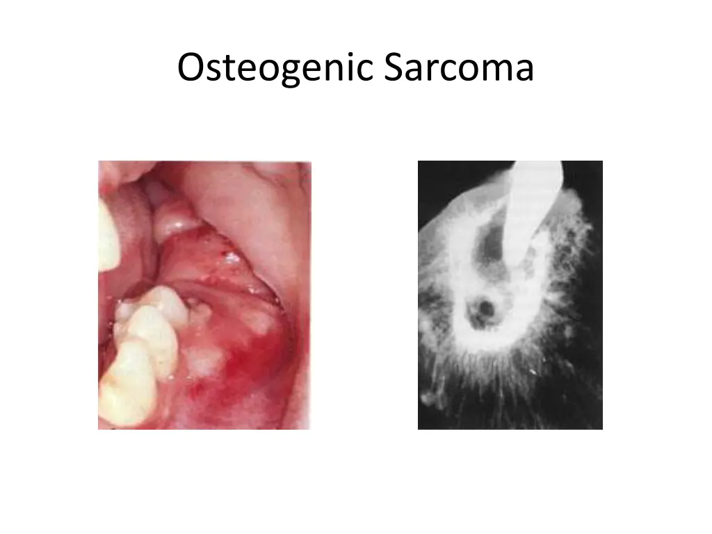 osteogenic sarcoma 6