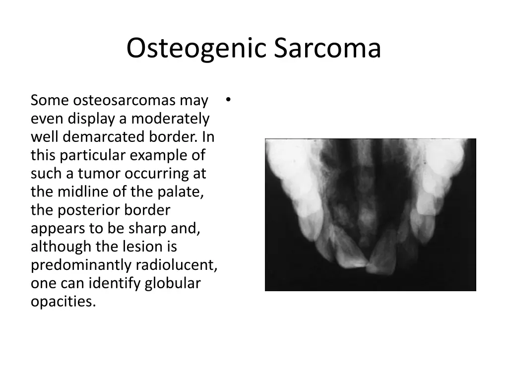 osteogenic sarcoma 7