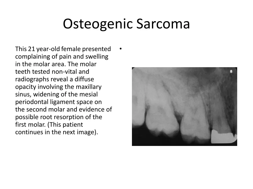 osteogenic sarcoma 8