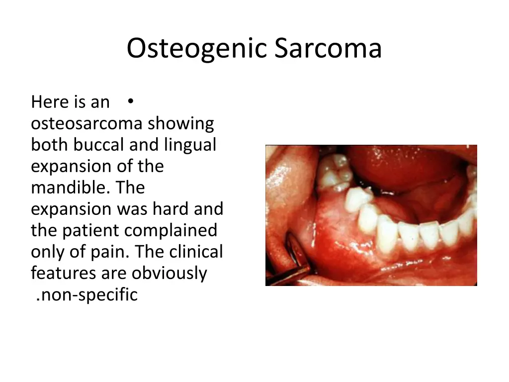 osteogenic sarcoma