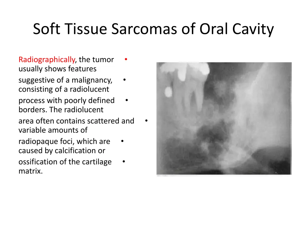 soft tissue sarcomas of oral cavity 10