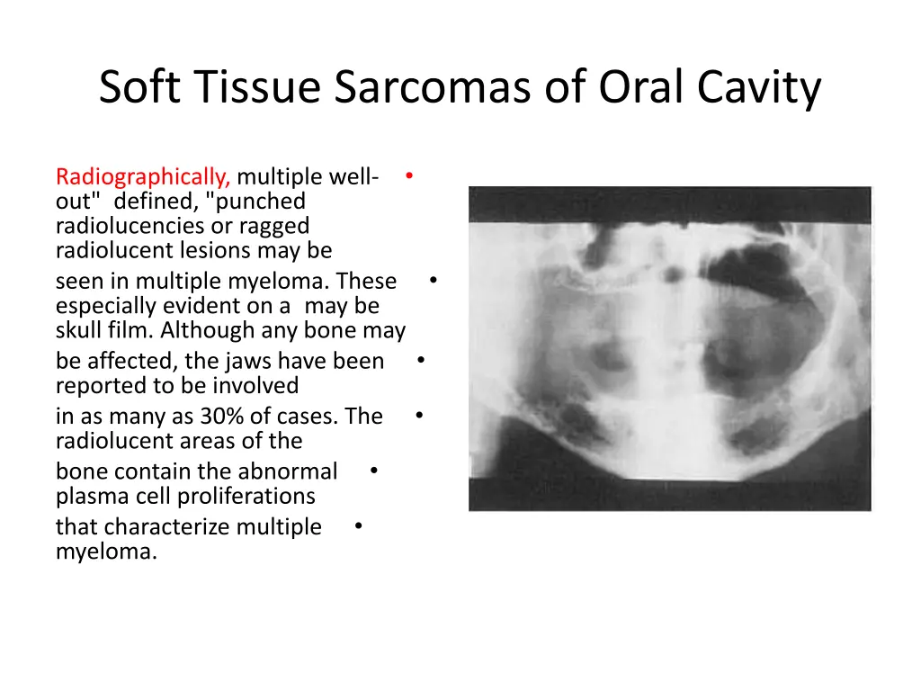 soft tissue sarcomas of oral cavity 15