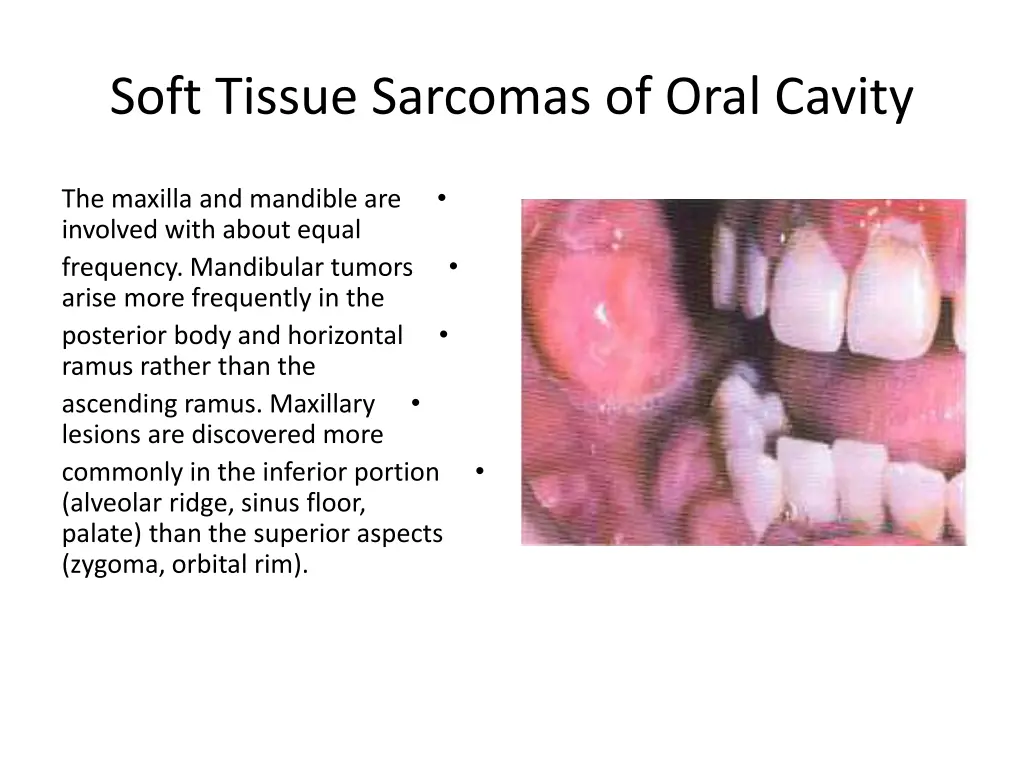 soft tissue sarcomas of oral cavity 2