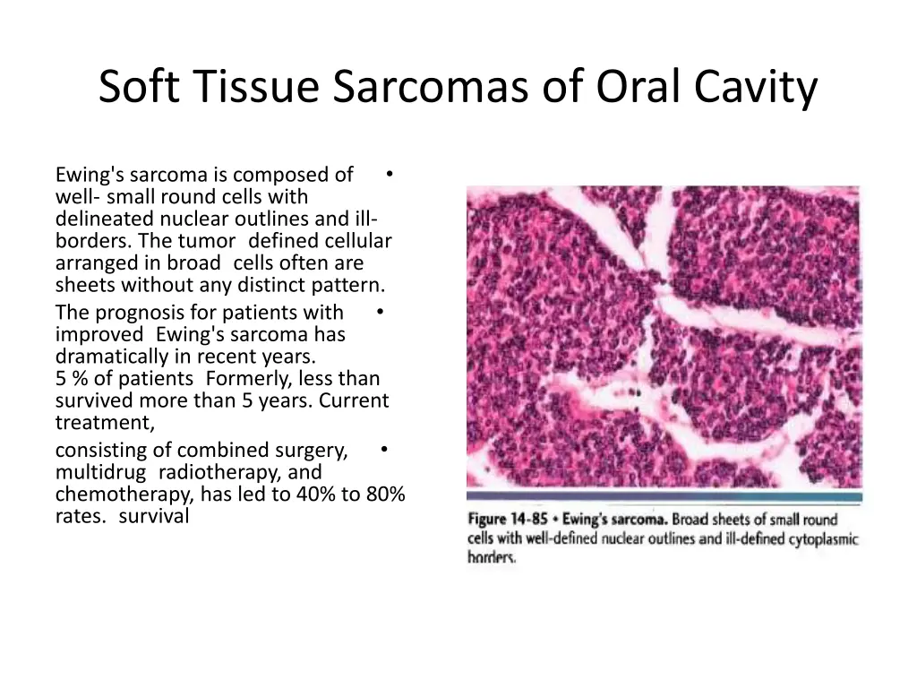soft tissue sarcomas of oral cavity 21