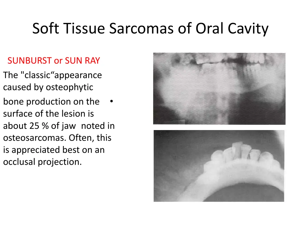 soft tissue sarcomas of oral cavity 5