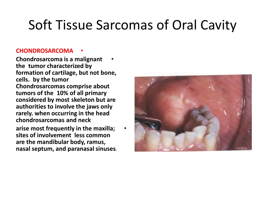 soft tissue sarcomas of oral cavity 8