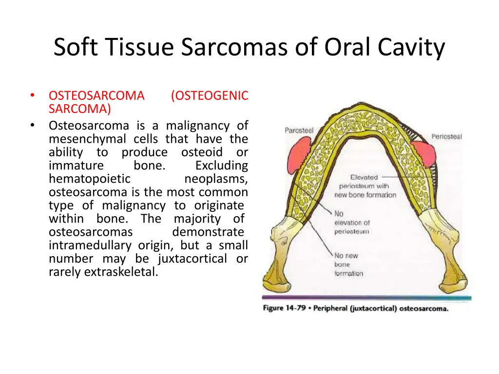 soft tissue sarcomas of oral cavity