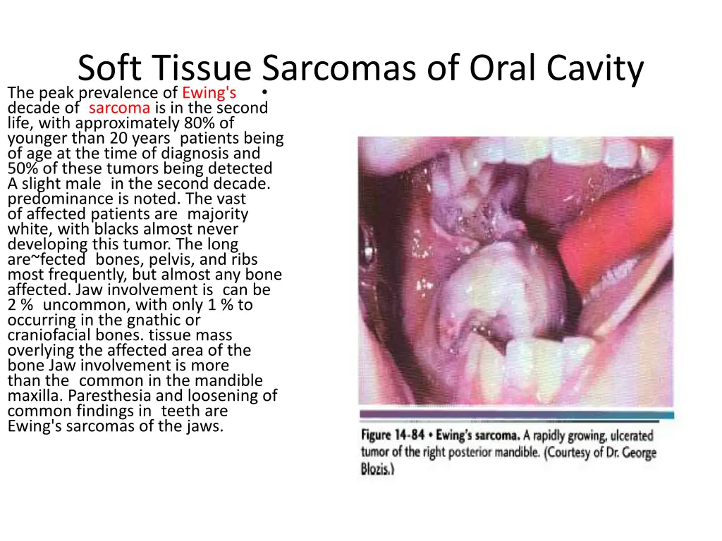 soft tissue sarcomas of oral cavity the peak