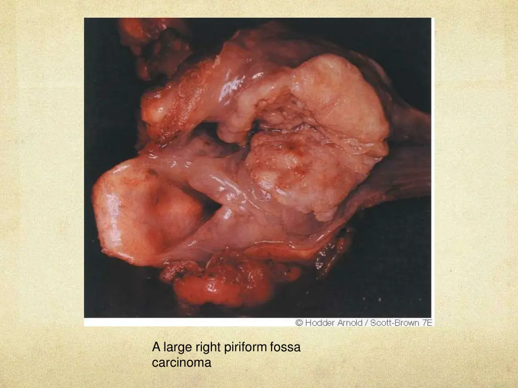 a large right piriform fossa carcinoma