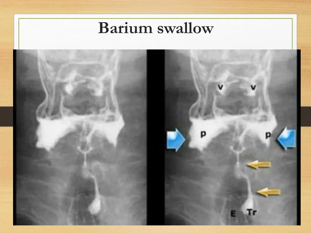 barium swallow