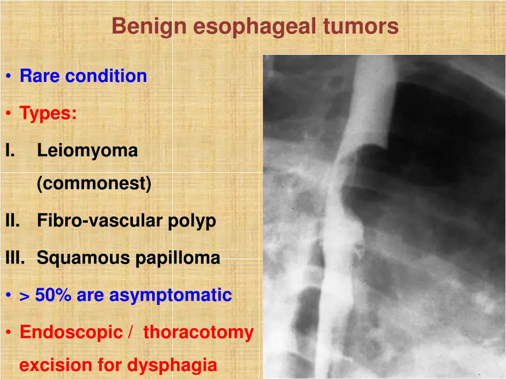 benign esophageal tumors