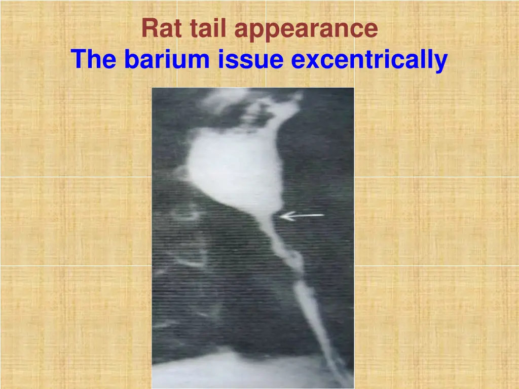 rat tail appearance the barium issue excentrically