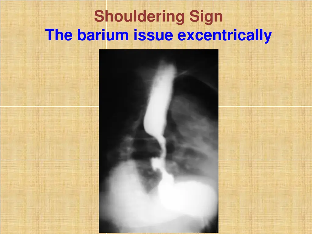 shouldering sign the barium issue excentrically