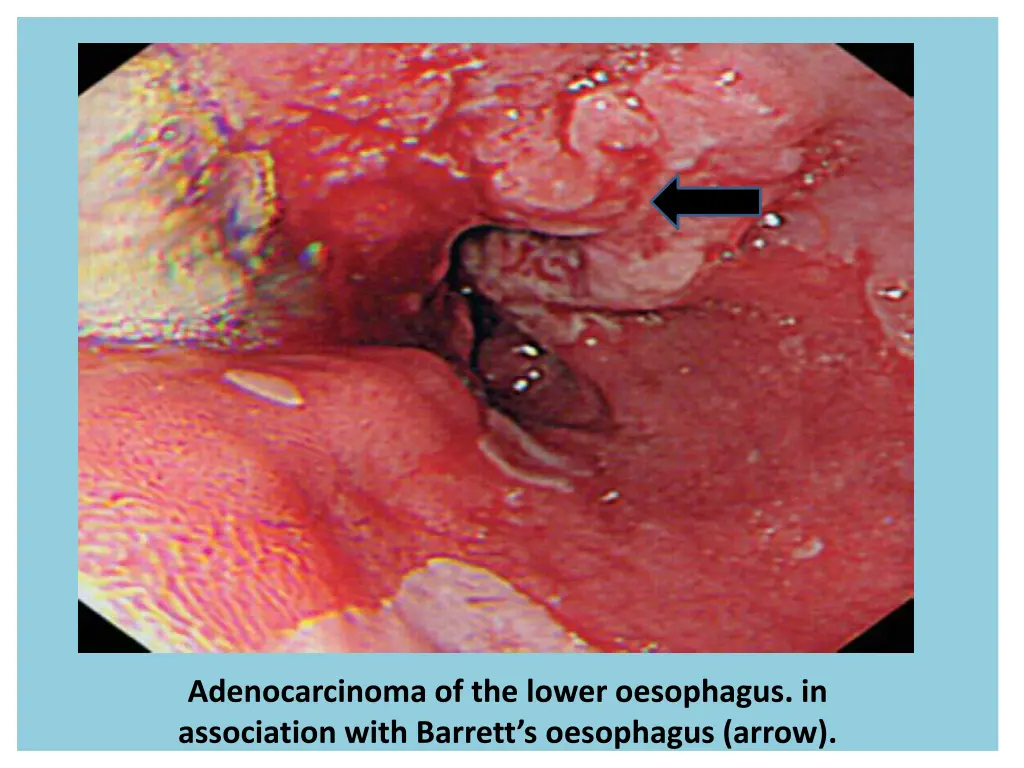 adenocarcinoma of the lower oesophagus
