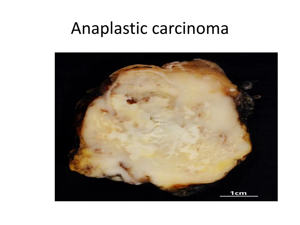 anaplastic carcinoma