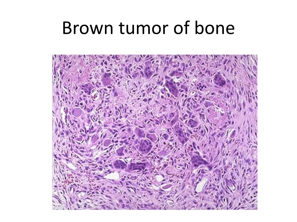 brown tumor of bone