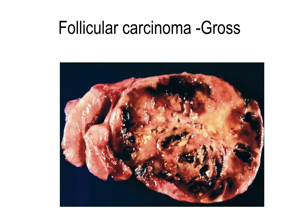 follicular carcinoma gross 1