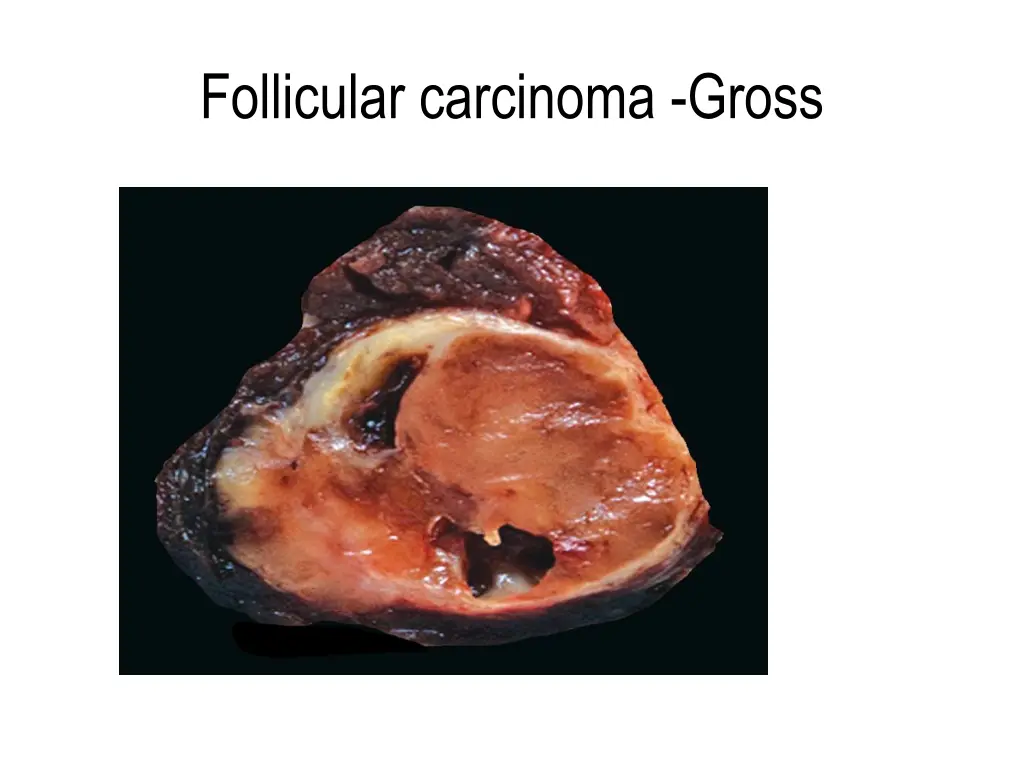 follicular carcinoma gross