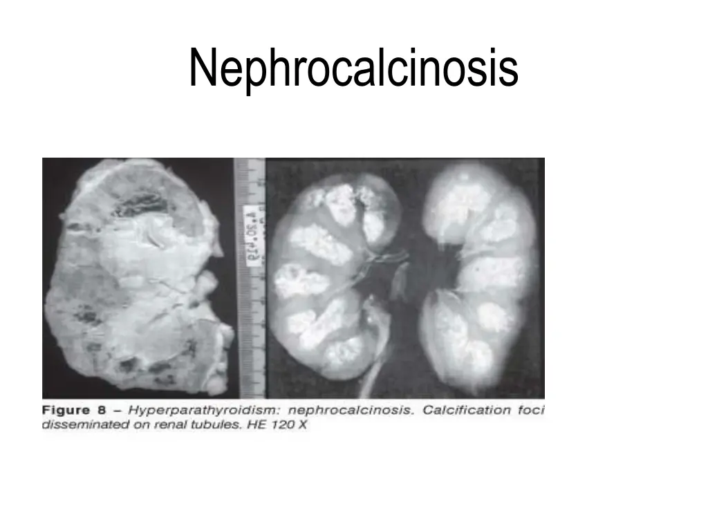 nephrocalcinosis