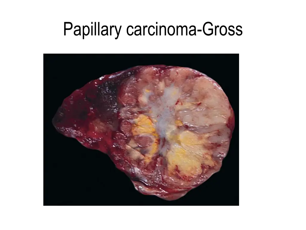 papillary carcinoma gross 1