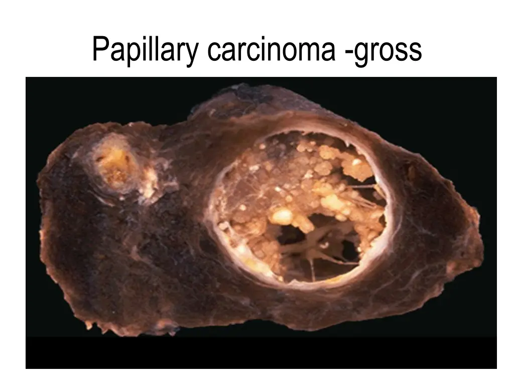 papillary carcinoma gross