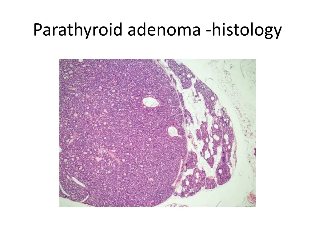 parathyroid adenoma histology