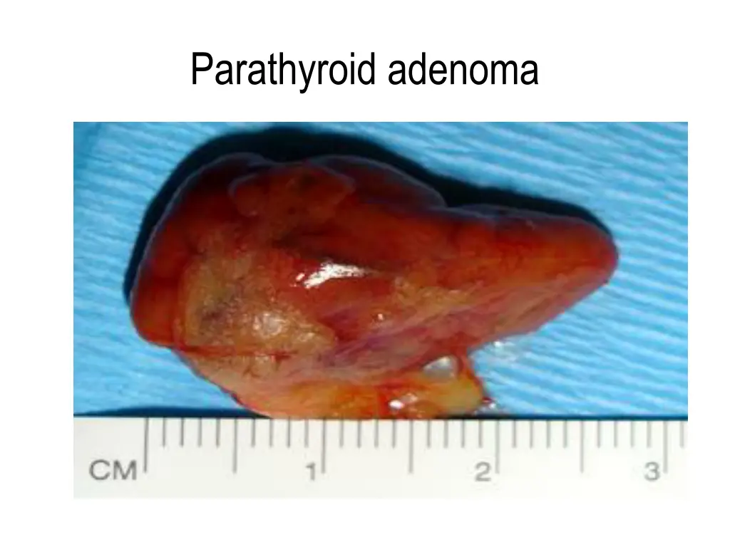 parathyroid adenoma