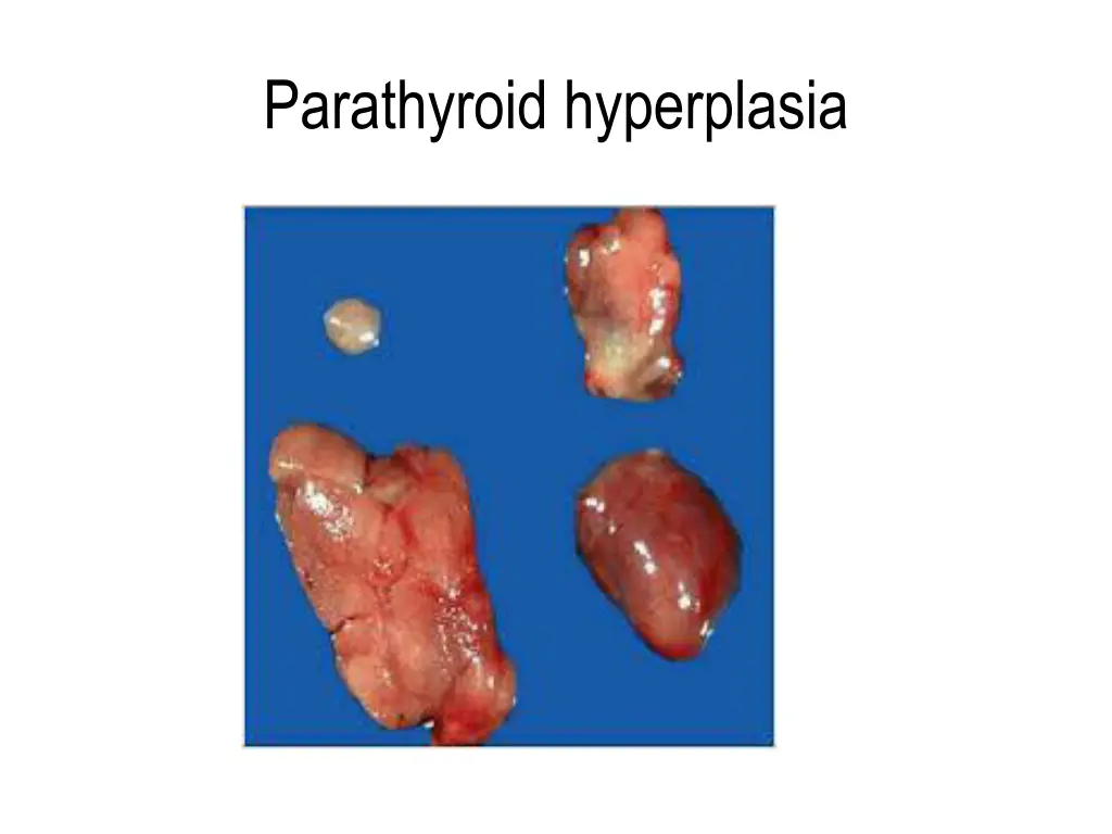 parathyroid hyperplasia
