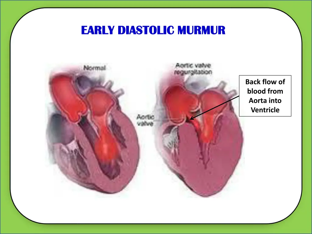 early diastolic murmur early diastolic murmur 1