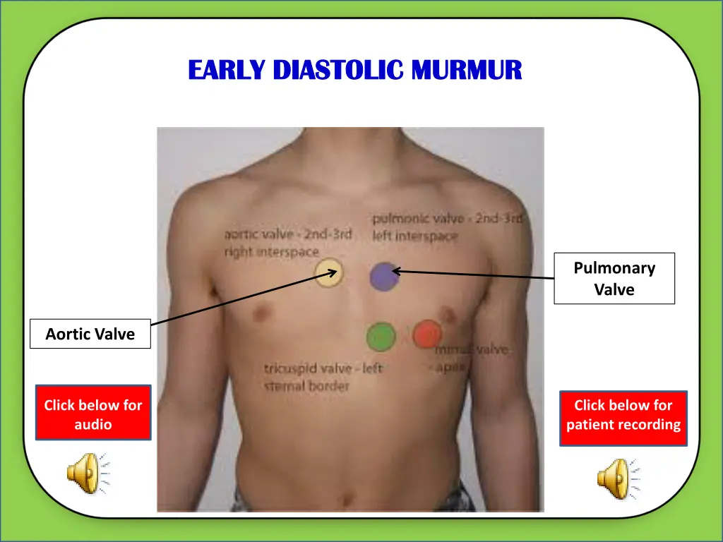 early diastolic murmur early diastolic murmur 4
