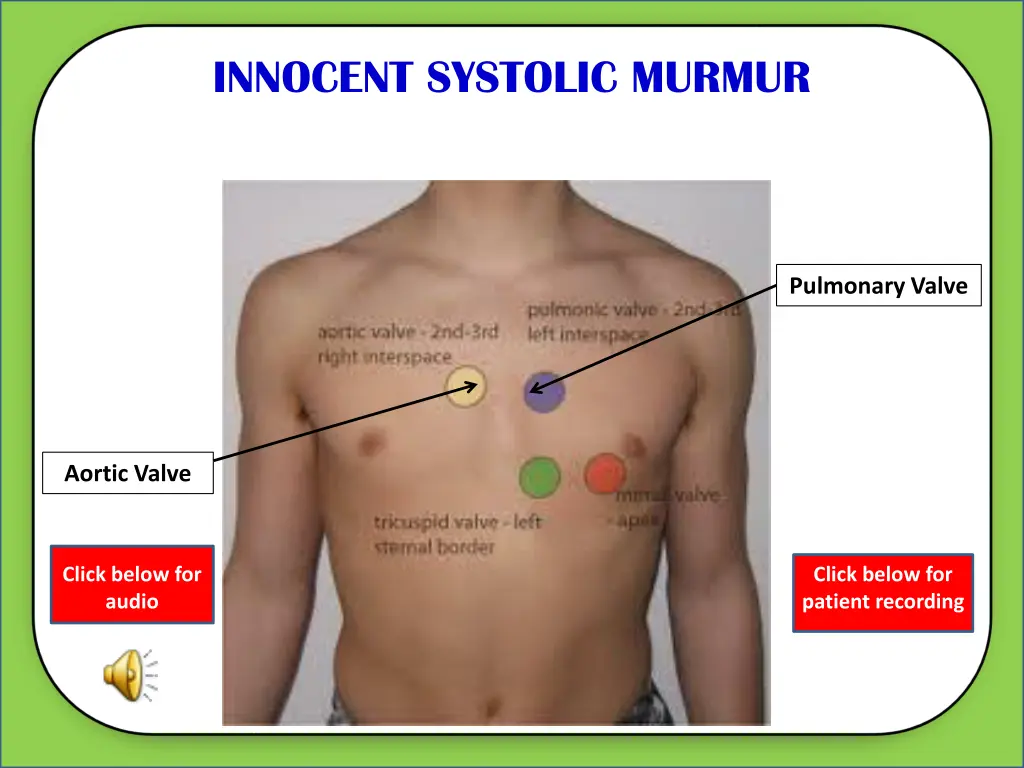 innocent systolic murmur 4