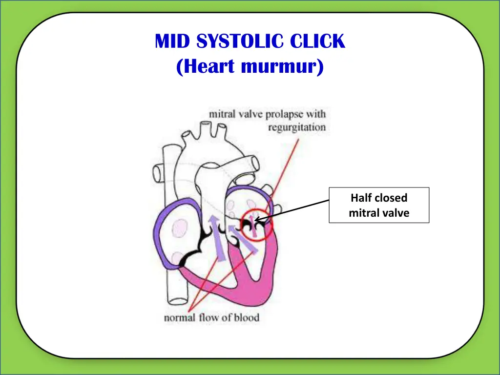 mid systolic click heart murmur 1