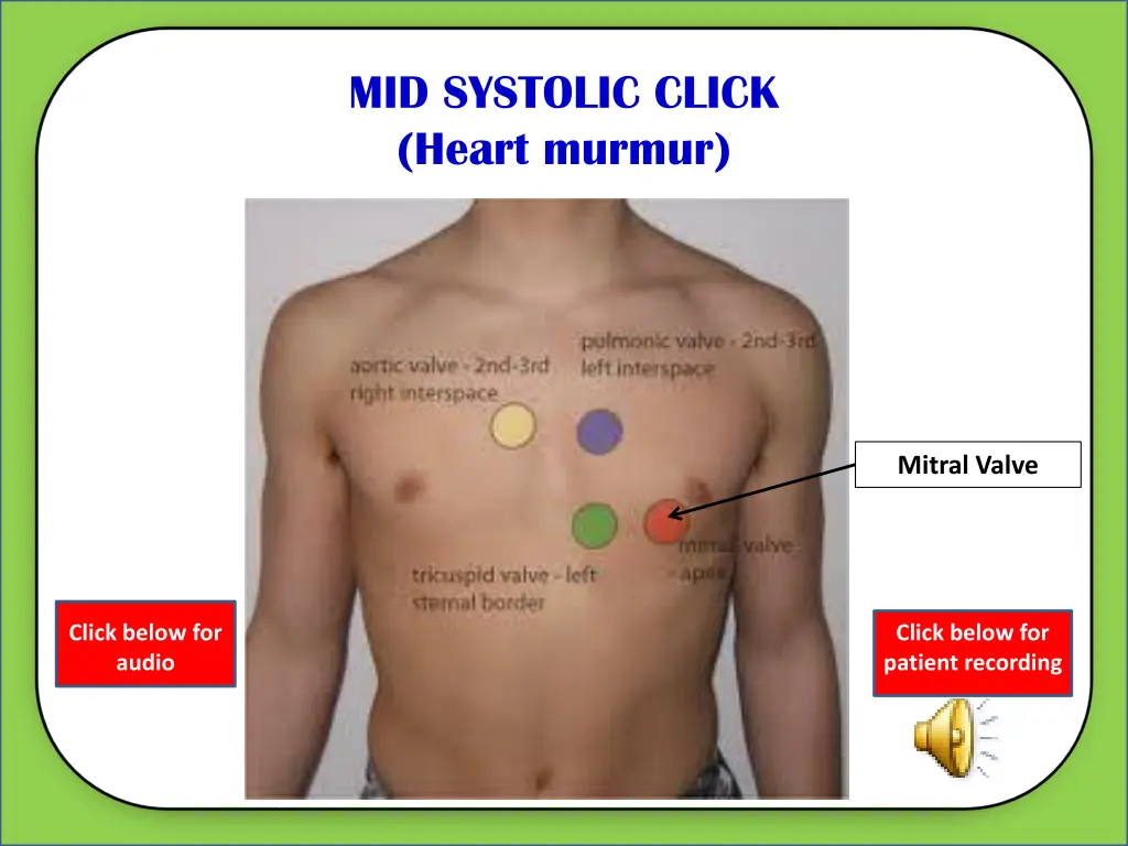 mid systolic click heart murmur 4