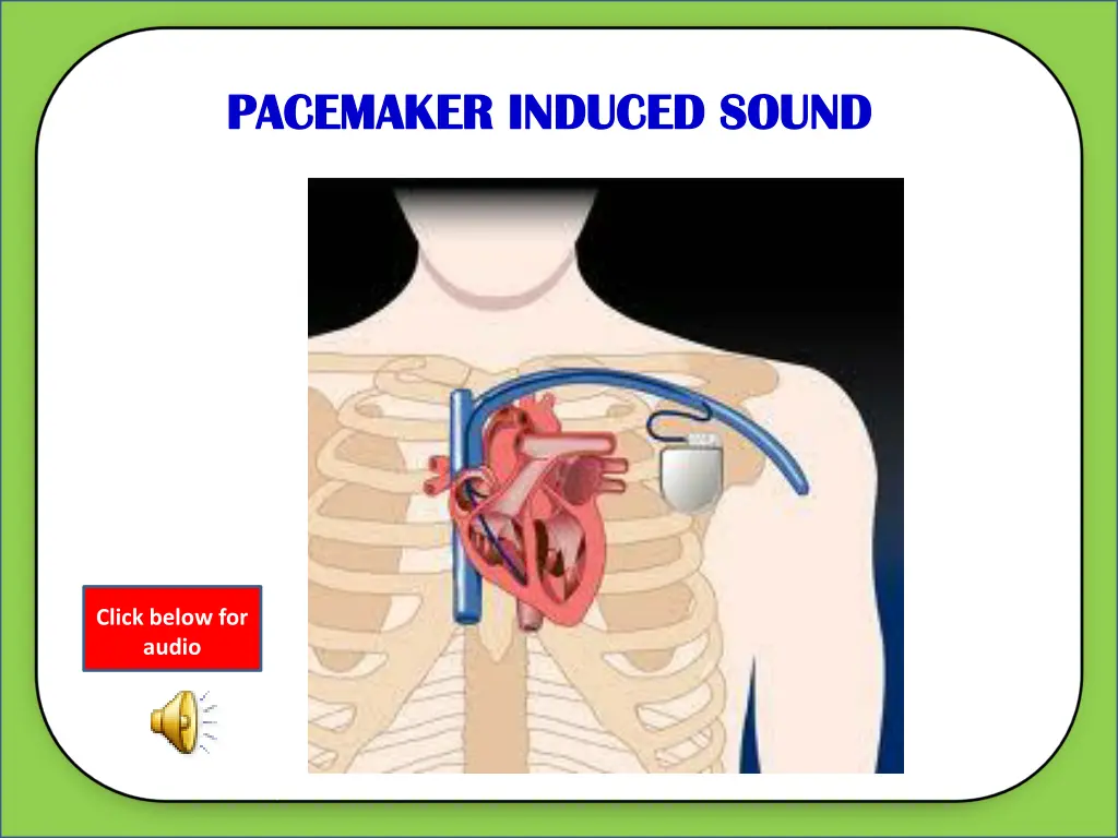 pacemaker induced sound pacemaker induced sound 1
