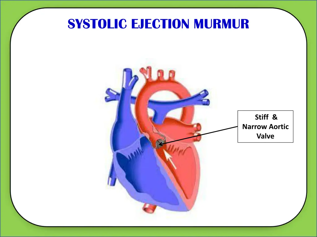 systolic ejection murmur 1