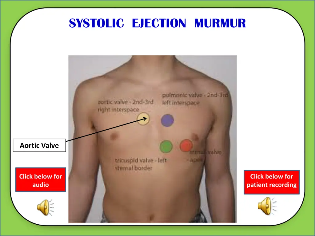 systolic ejection murmur 4
