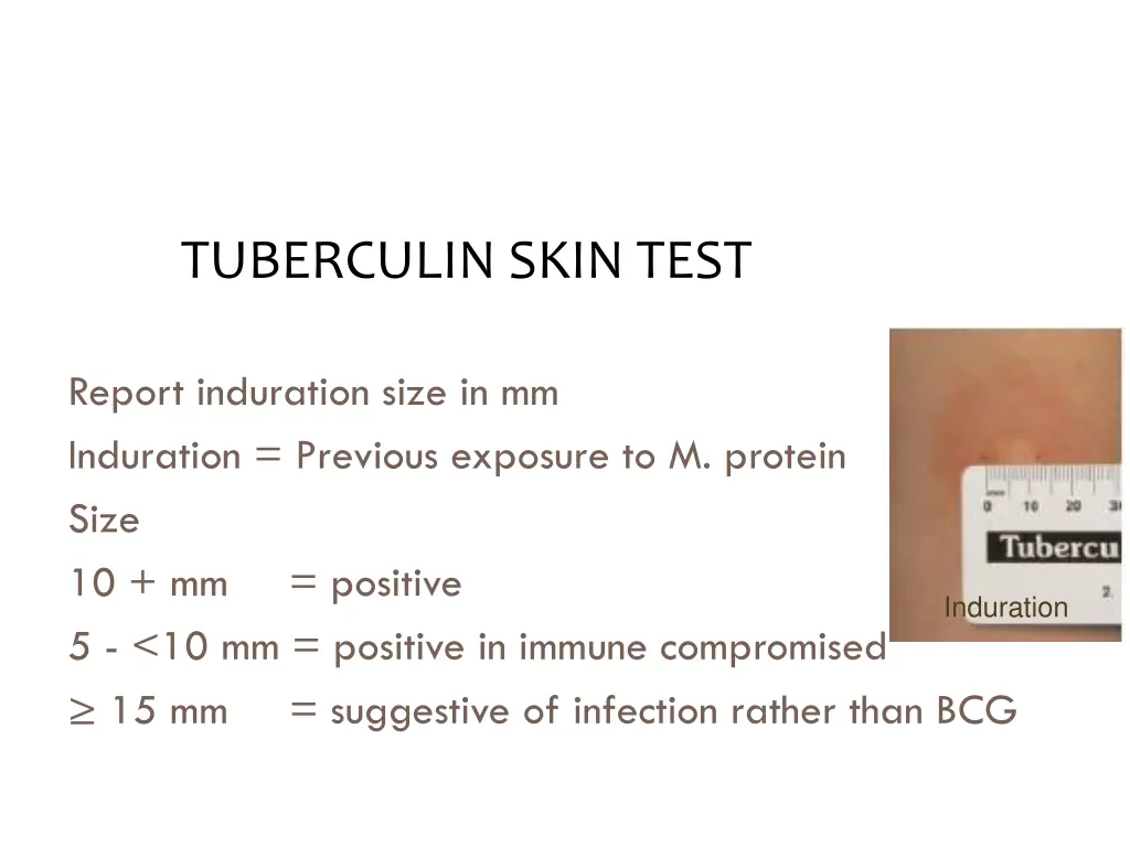 tuberculin skin test 1