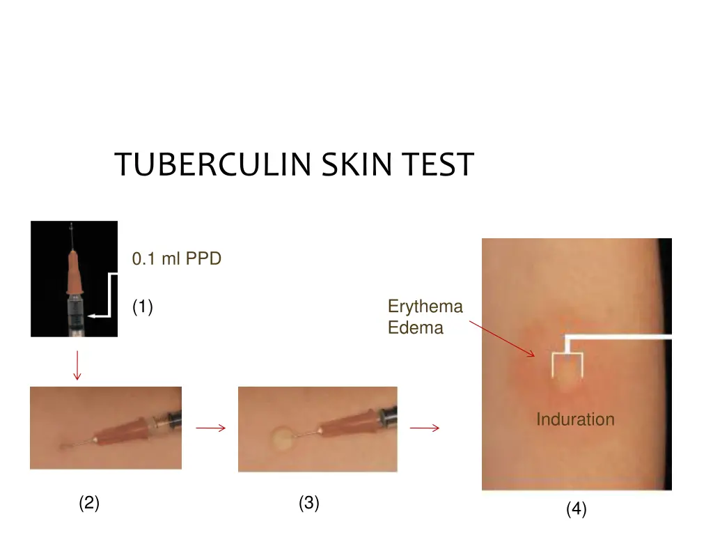 tuberculin skin test