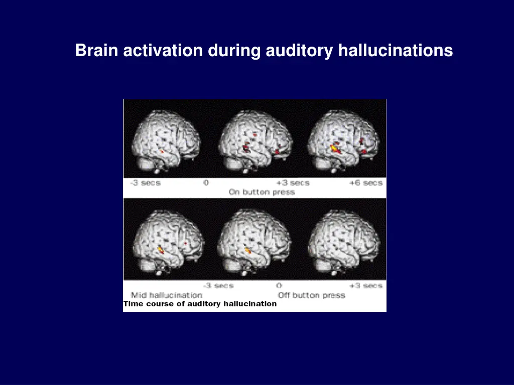 brain activation during auditory hallucinations